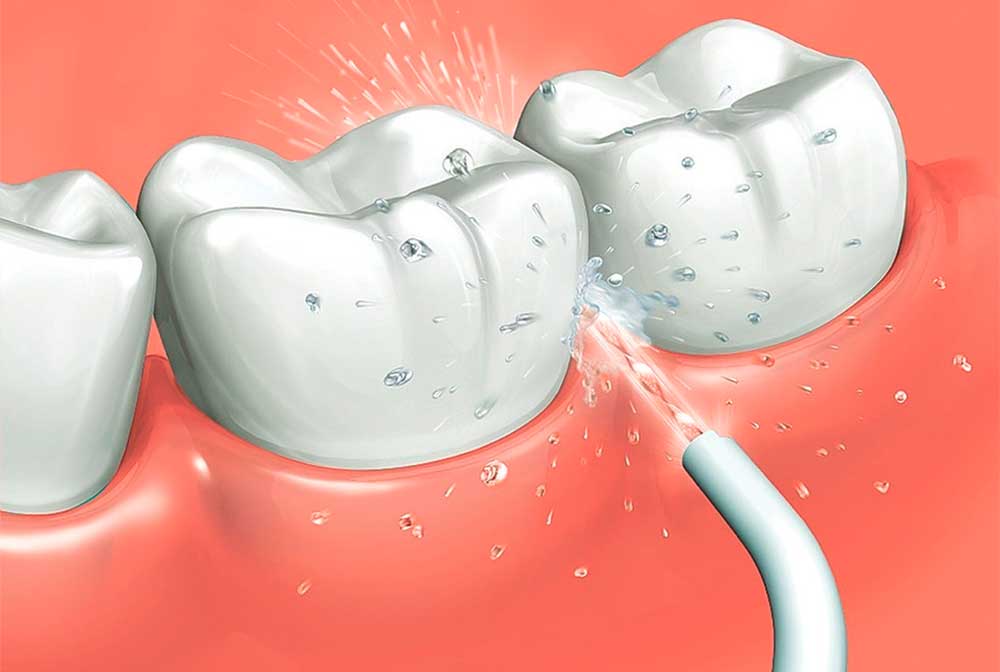 IRRIGADOR ORAL LIMPIEZA PROFUNDA